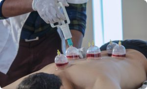 Sringavacharana: The Healing Power of Cupping Therapy for Holistic Health 2 blog image